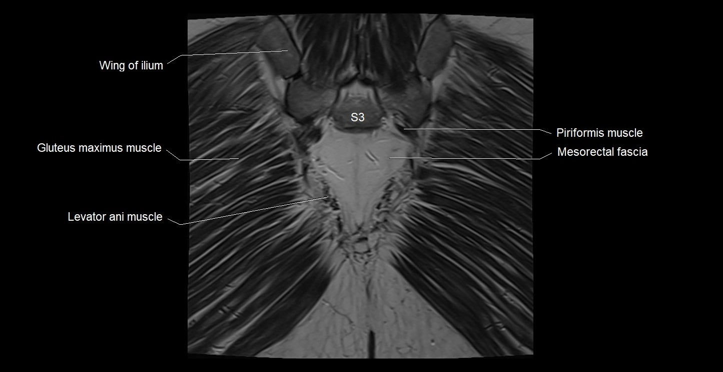 MRI coronal cross sectional anatomy male pelvis image 38.webp